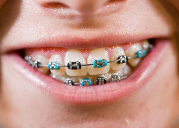 Coloured Braces, Langley Dentist