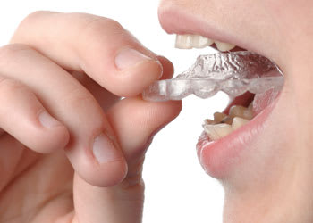 Invisalign Clear Braces, Langley Dentist