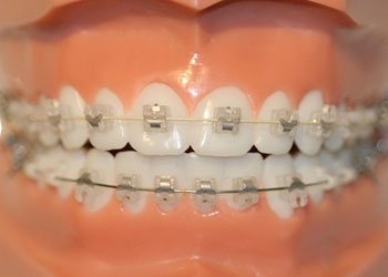In-Ovation Braces, Langley Dentist
