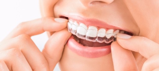 Invisalign Benefits, Langely Dentist