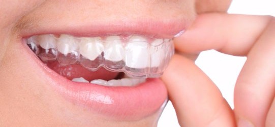 Invisalign Clear Braces, Langley Dentist