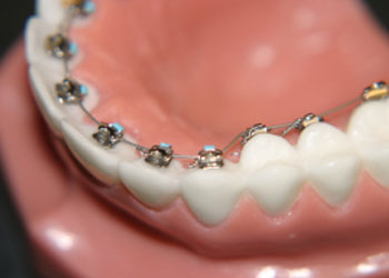 Clear Braces: What Are They? - Oak Tree Dental Ashburn Virginia